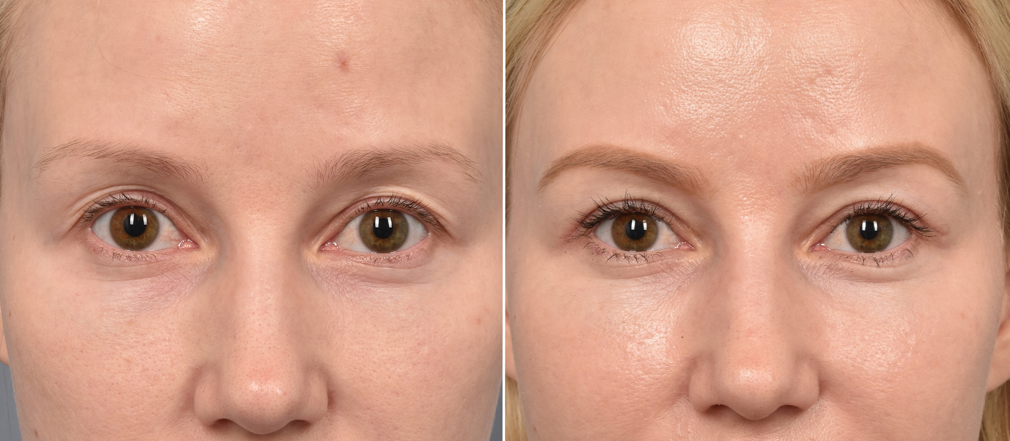 Upper Blepharoplasty Before & After Gallery - Patient 103380 - Image 1