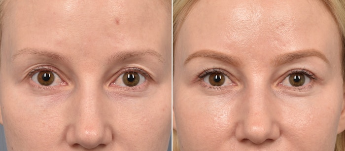Upper Blepharoplasty Before & After Gallery - Patient 103380 - Image 1