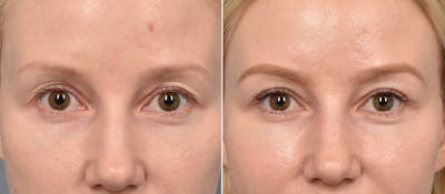 Upper Blepharoplasty Before & After Gallery - Patient 103380 - Image 1