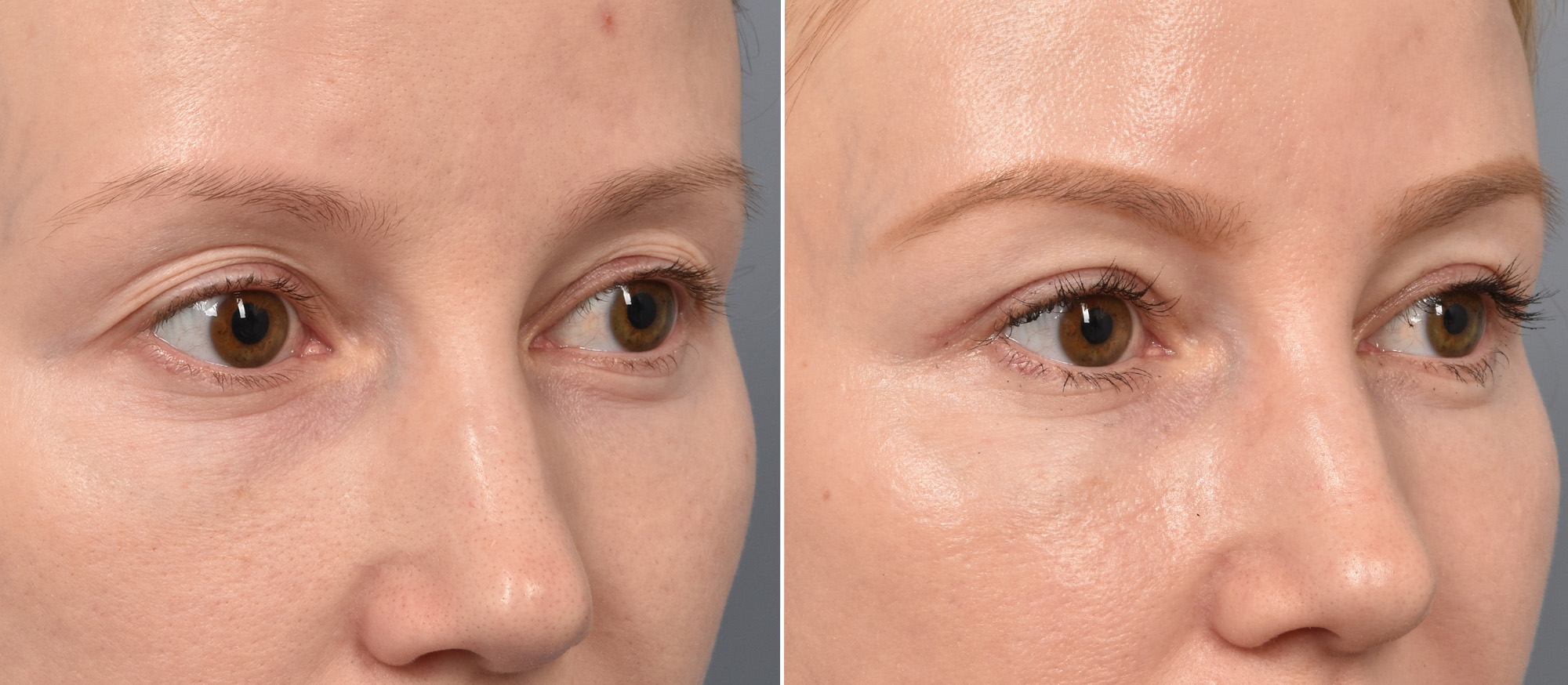 Upper Blepharoplasty Before & After Gallery - Patient 103380 - Image 2