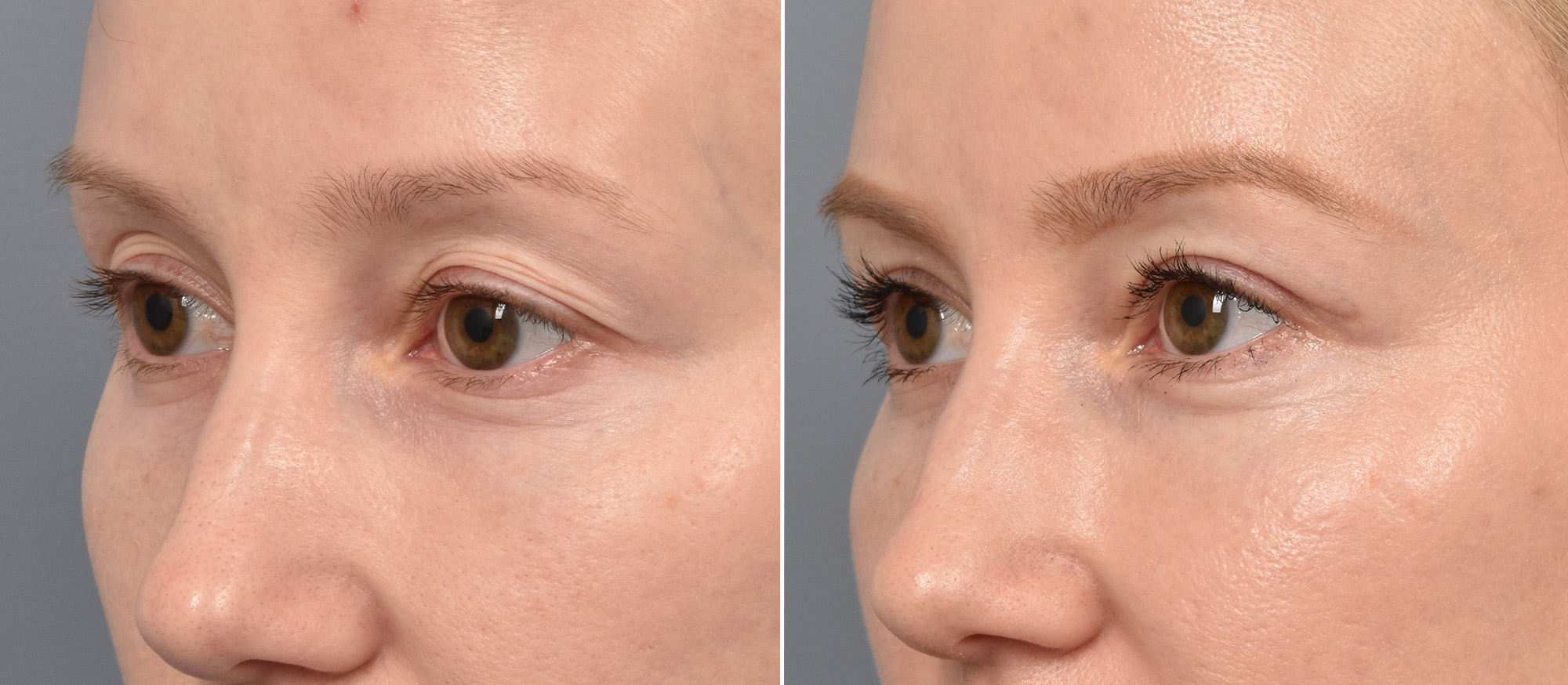 Upper Blepharoplasty Before & After Gallery - Patient 103380 - Image 3