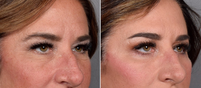 Upper Blepharoplasty Before & After Gallery - Patient 239766 - Image 1