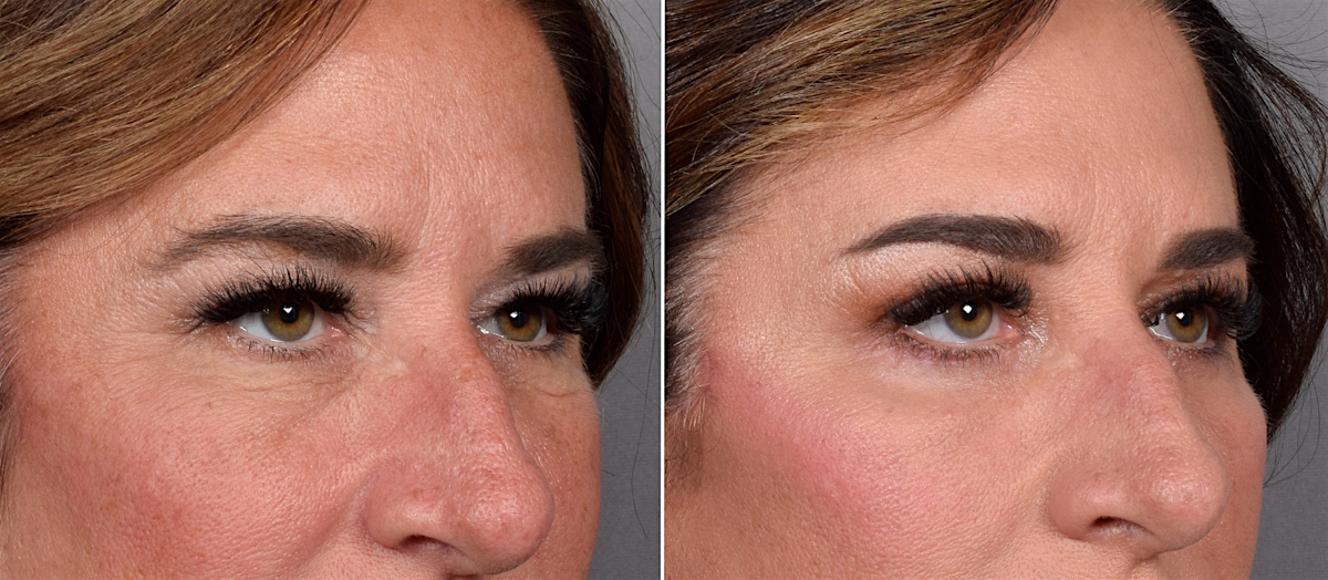 Upper Blepharoplasty Before & After Gallery - Patient 239766 - Image 1