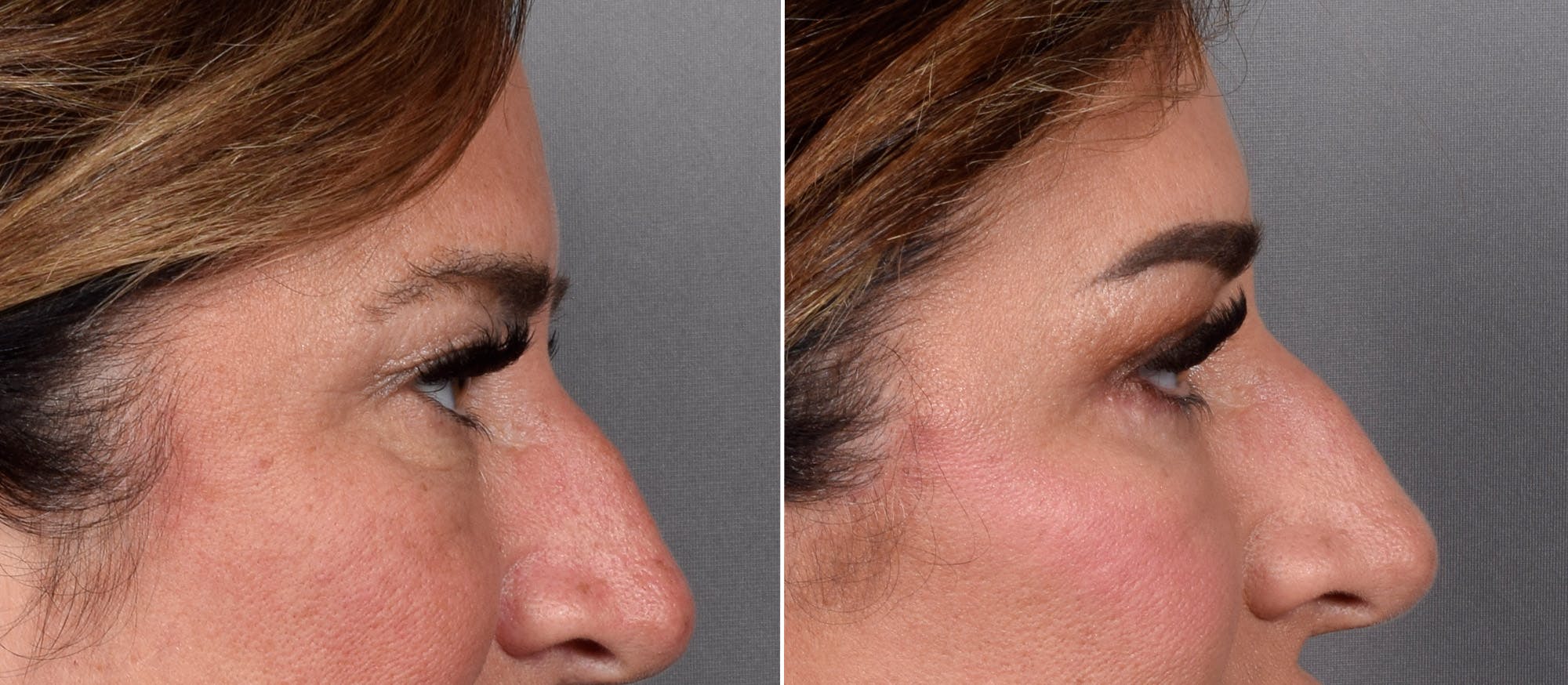 Upper Blepharoplasty Before & After Gallery - Patient 239766 - Image 2