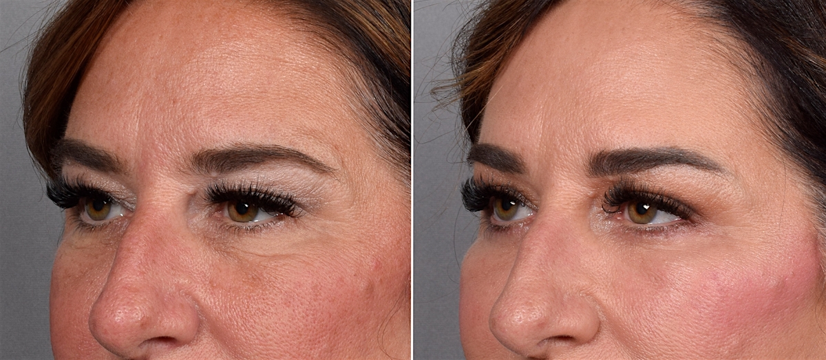 Upper Blepharoplasty Before & After Gallery - Patient 239766 - Image 3
