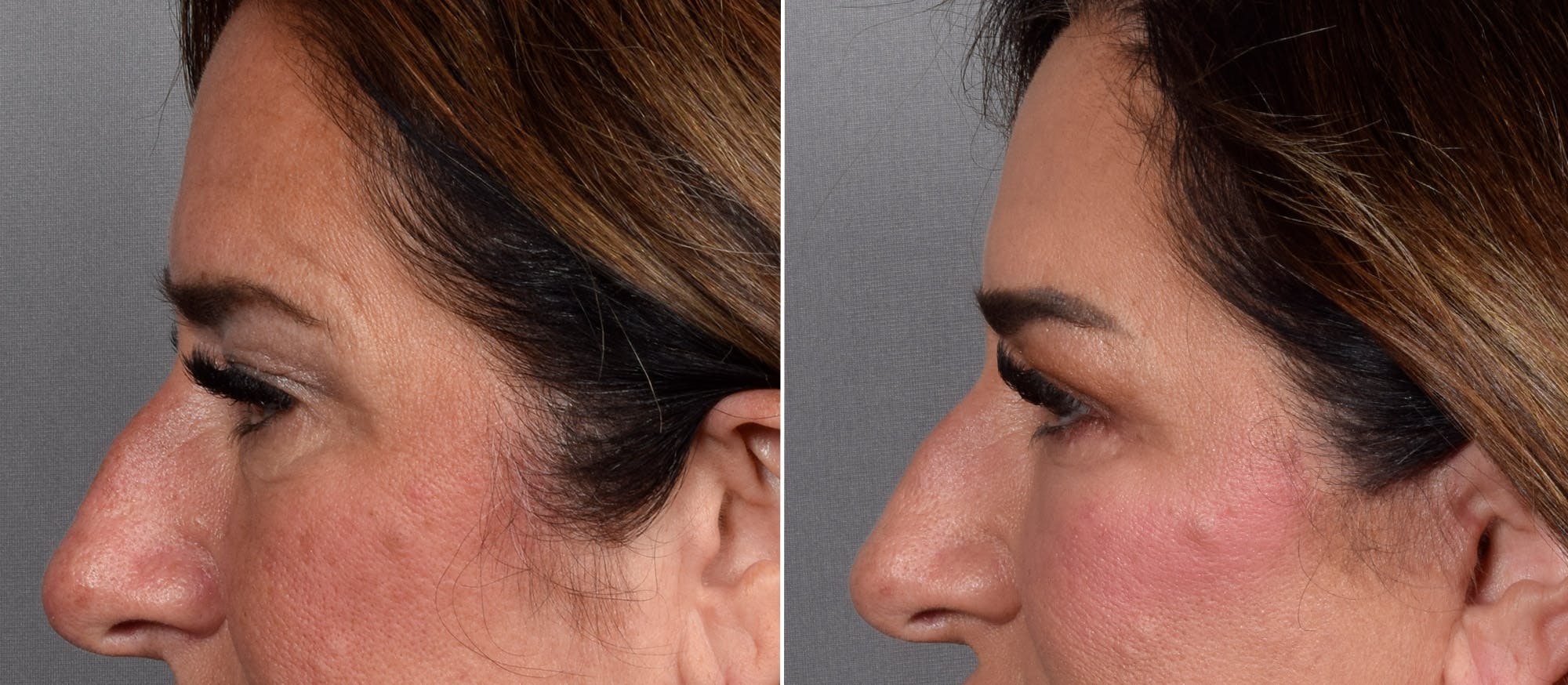 Upper Blepharoplasty Before & After Gallery - Patient 239766 - Image 4