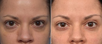 Lower Blepharoplasty Before & After Gallery - Patient 424741 - Image 1