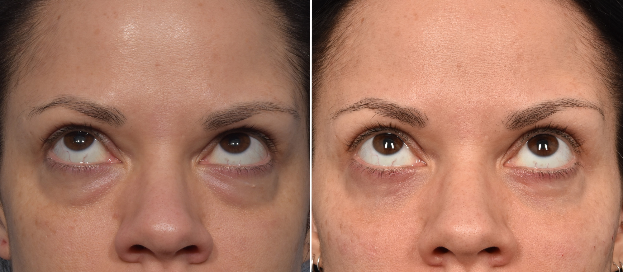 Lower Blepharoplasty Before & After Gallery - Patient 424741 - Image 2