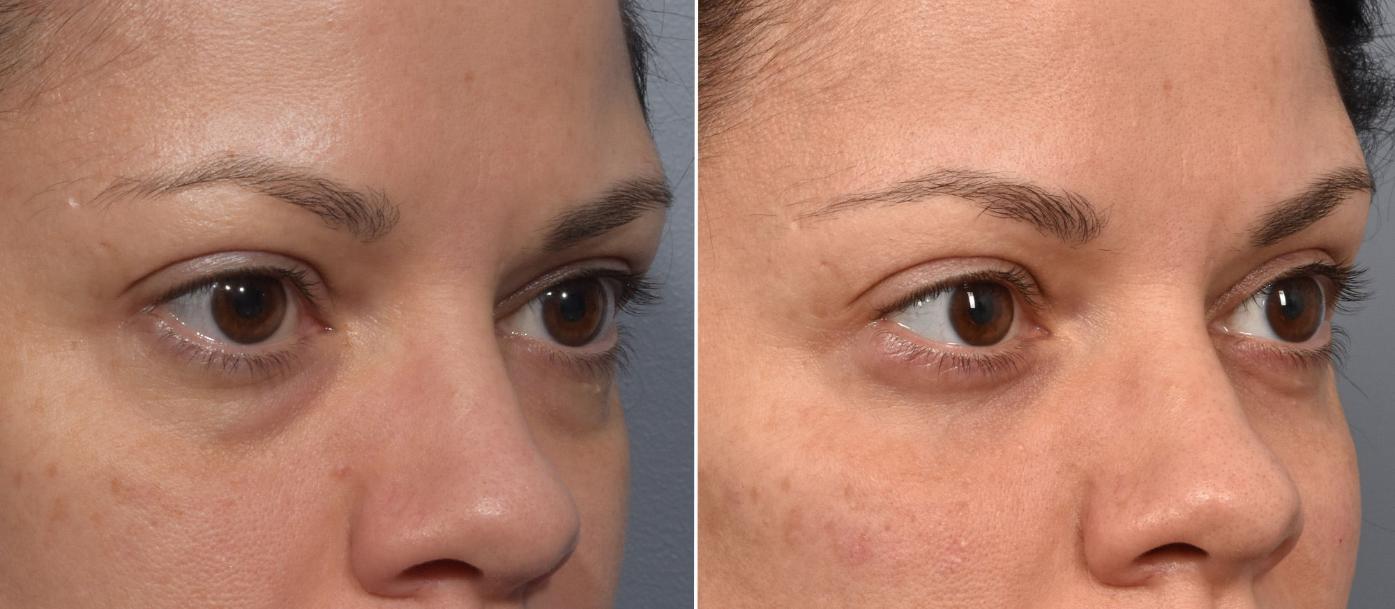 Lower Blepharoplasty Before & After Gallery - Patient 424741 - Image 3