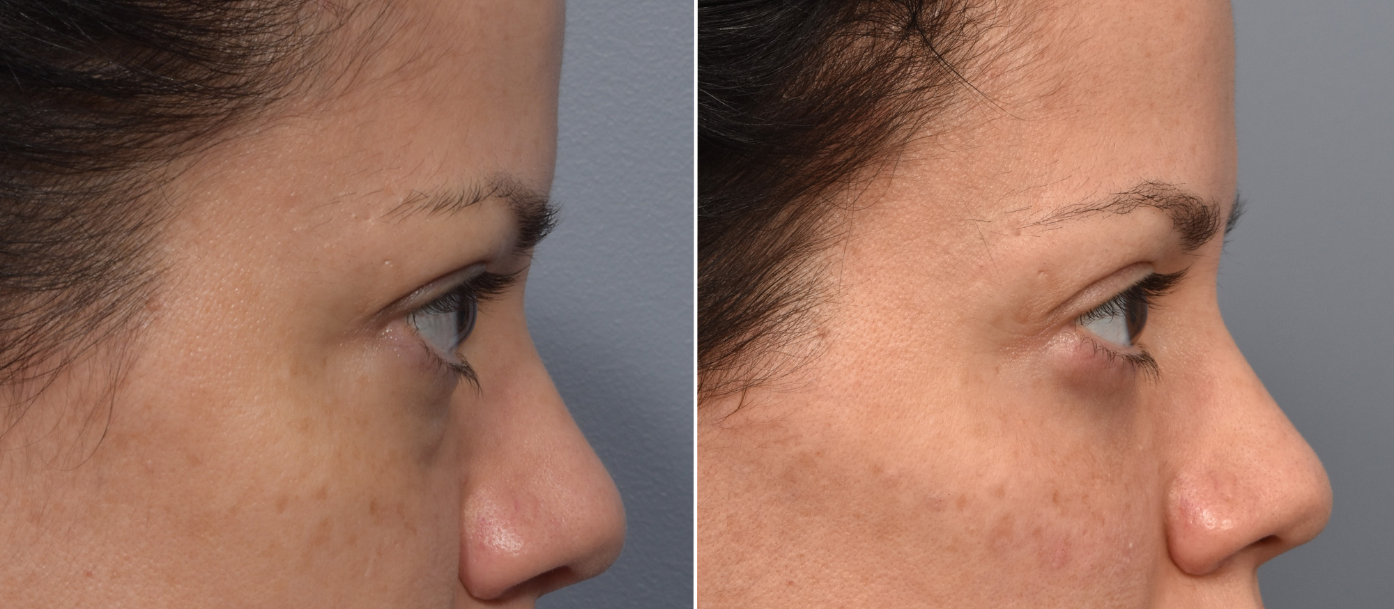 Lower Blepharoplasty Before & After Gallery - Patient 424741 - Image 4