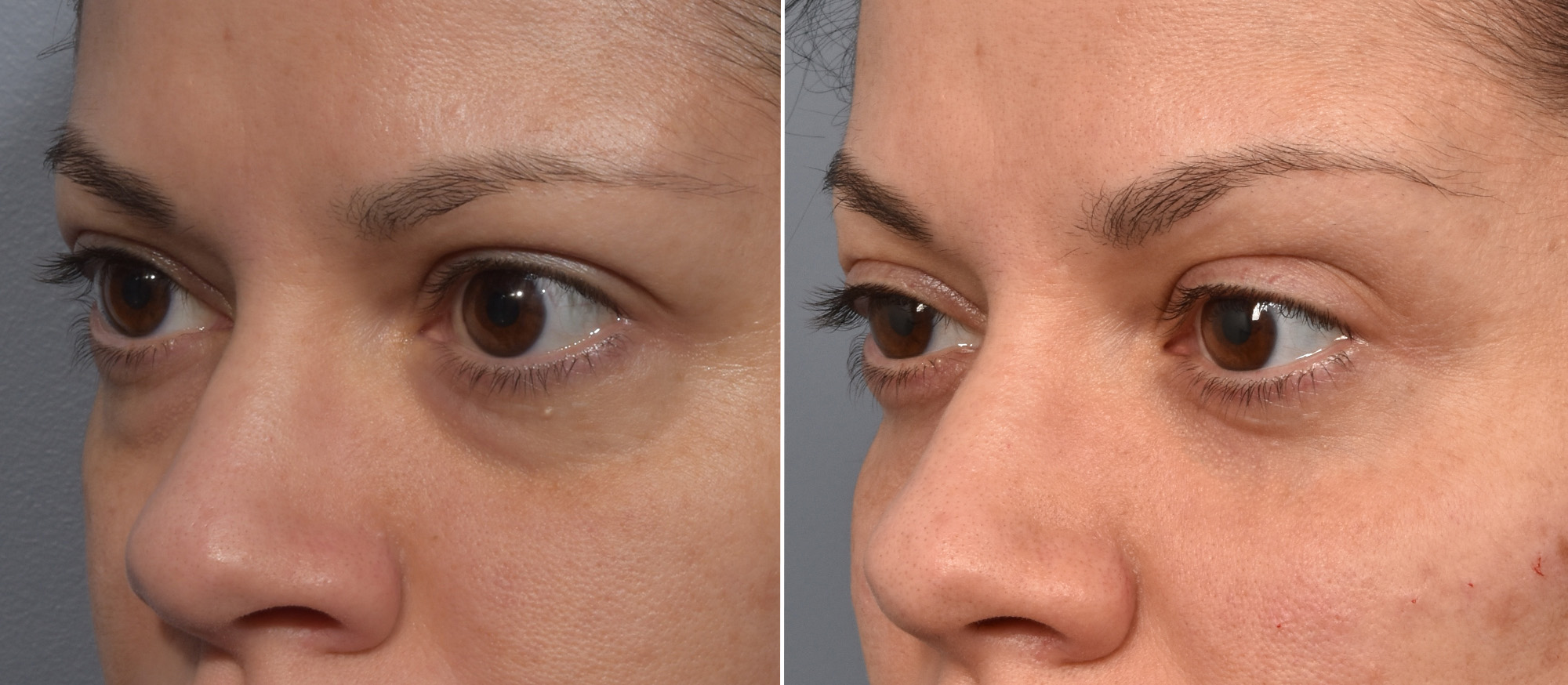Lower Blepharoplasty Before & After Gallery - Patient 424741 - Image 5
