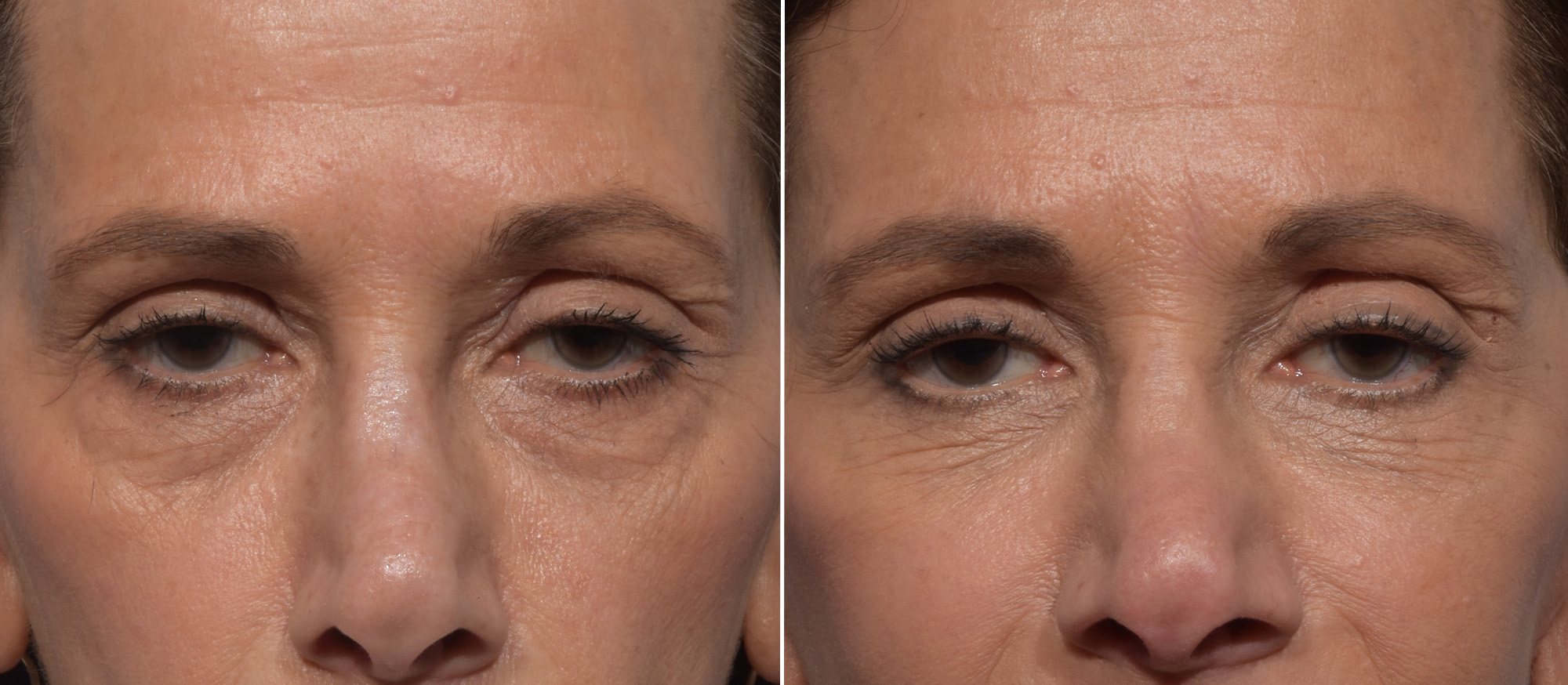 Lower Blepharoplasty Before & After Gallery - Patient 182904 - Image 1