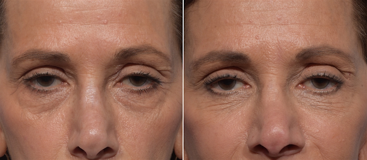 Lower Blepharoplasty Before & After Gallery - Patient 182904 - Image 1
