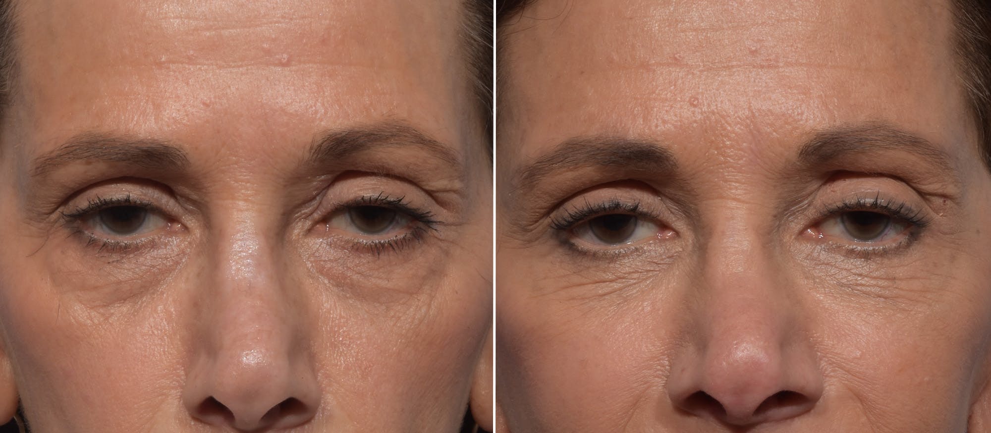 Lower Blepharoplasty Before & After Gallery - Patient 182904 - Image 1