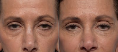 Lower Blepharoplasty Before & After Gallery - Patient 182904 - Image 1