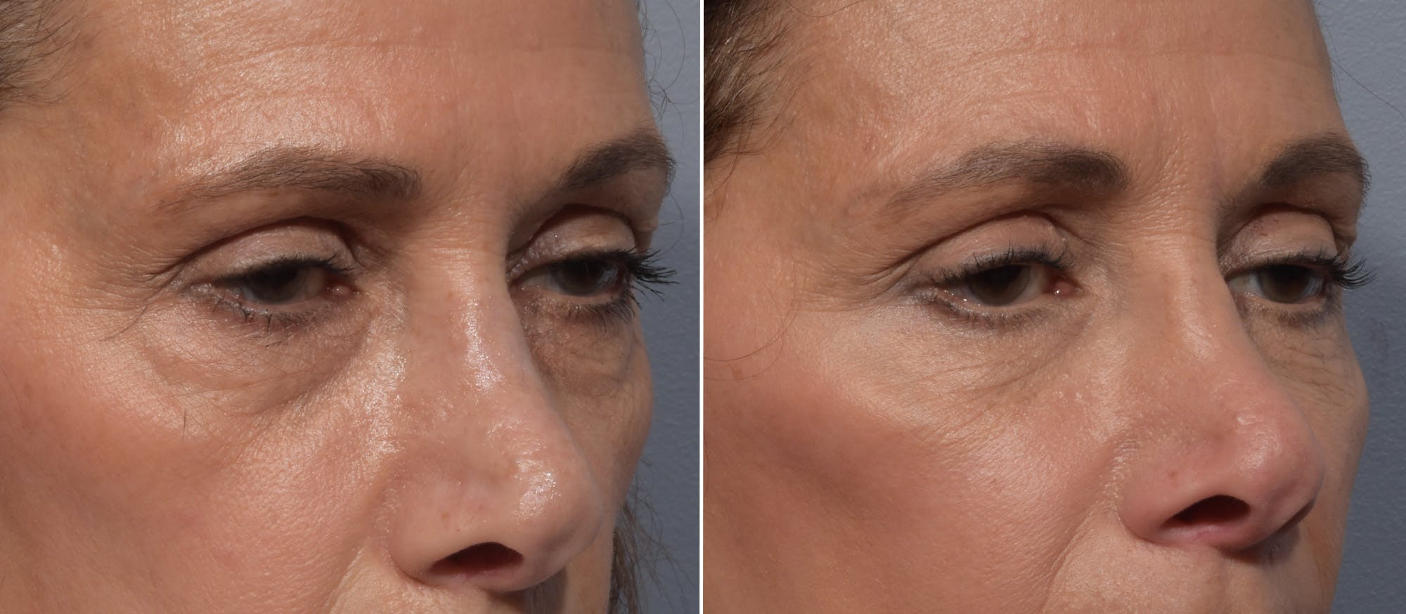 Lower Blepharoplasty Before & After Gallery - Patient 182904 - Image 2