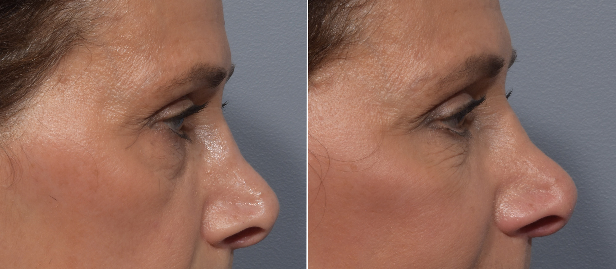 Lower Blepharoplasty Before & After Gallery - Patient 182904 - Image 3