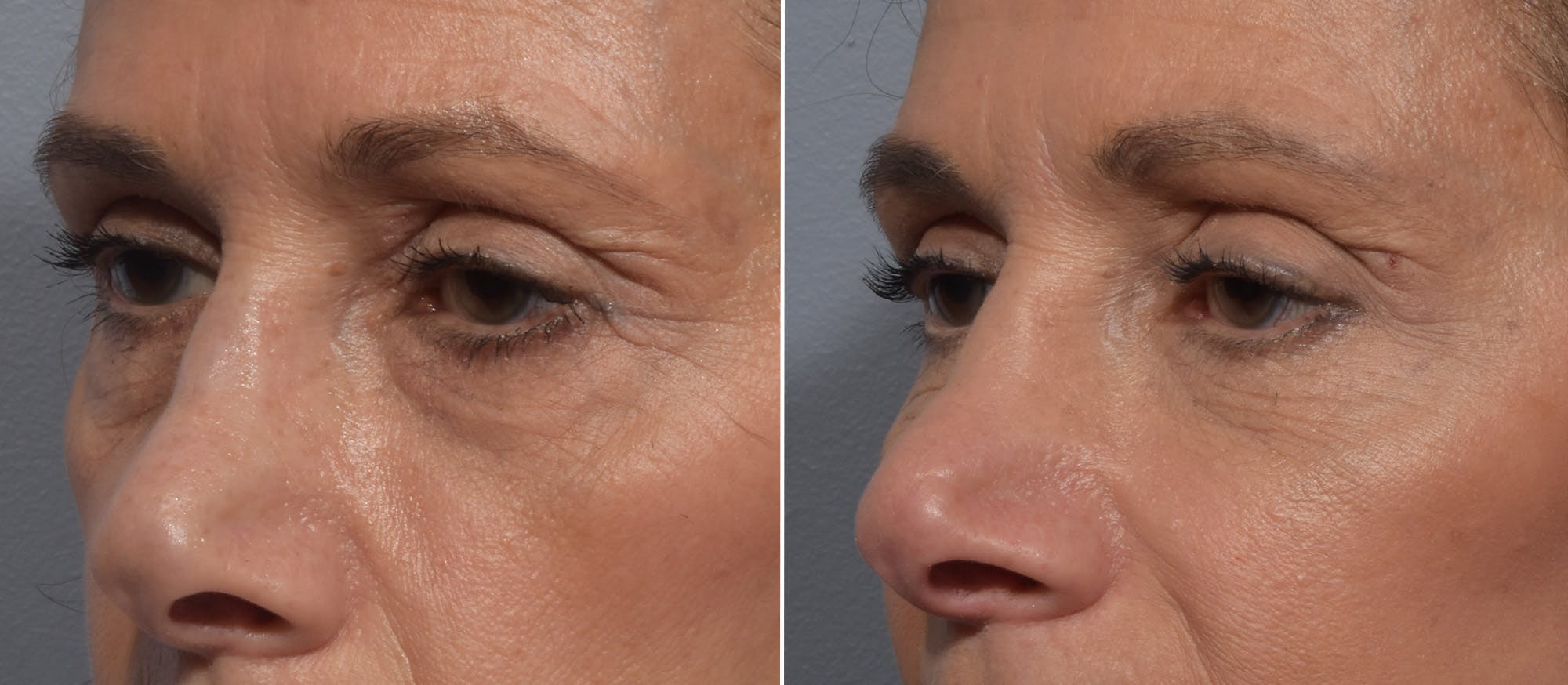 Lower Blepharoplasty Before & After Gallery - Patient 182904 - Image 4