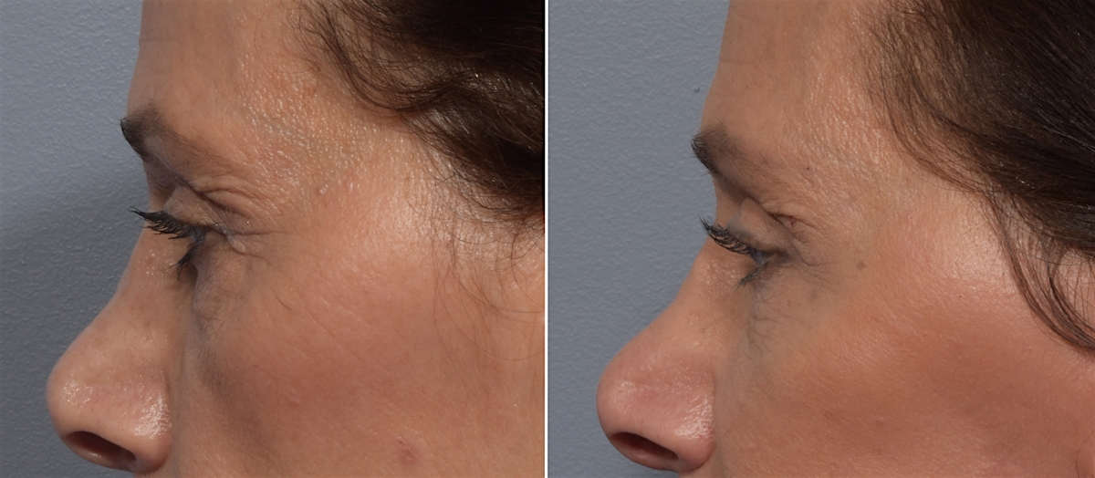 Lower Blepharoplasty Before & After Gallery - Patient 182904 - Image 5