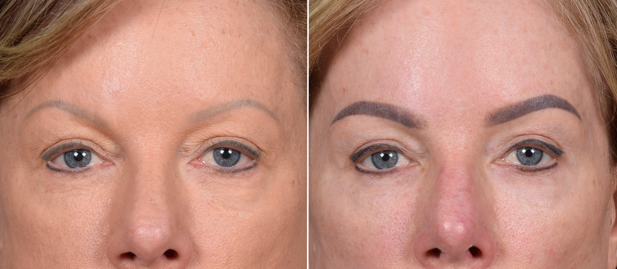 CO2 Laser Before & After Gallery - Patient 401436 - Image 8