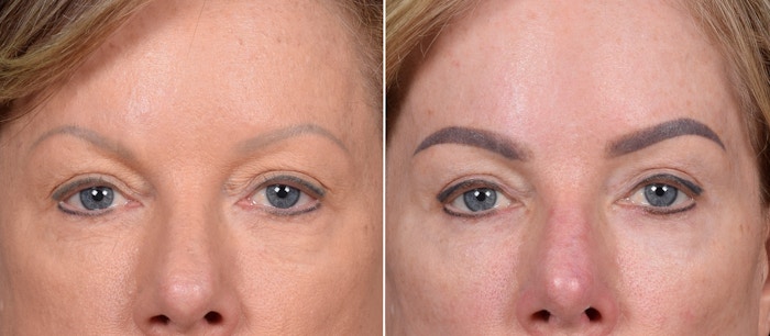 Upper Blepharoplasty Before & After Gallery - Patient 133423 - Image 1