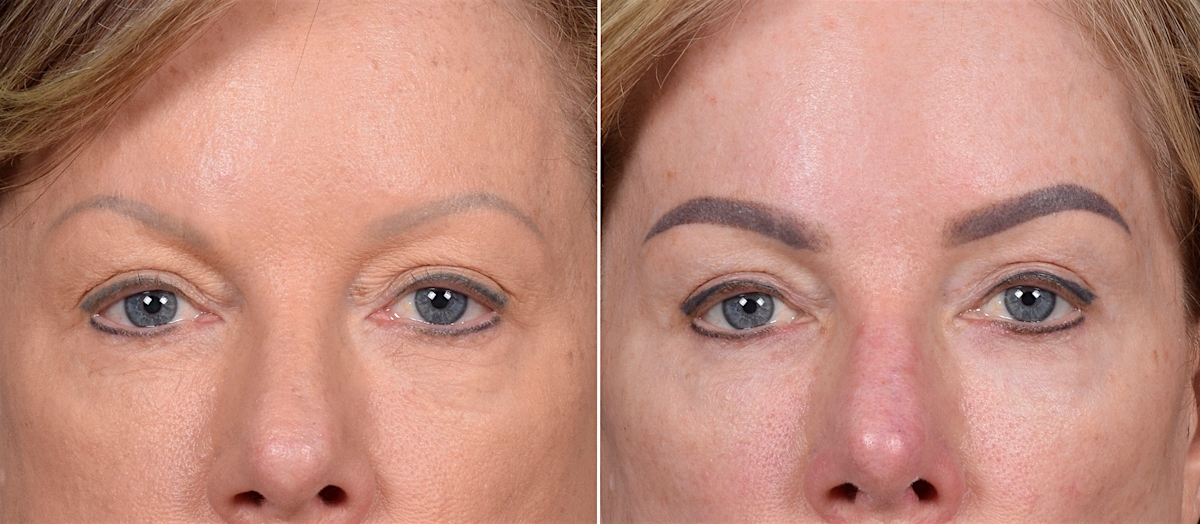 CO2 Laser Before & After Gallery - Patient 401436 - Image 8