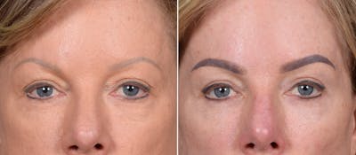 Upper Blepharoplasty Before & After Gallery - Patient 133423 - Image 1