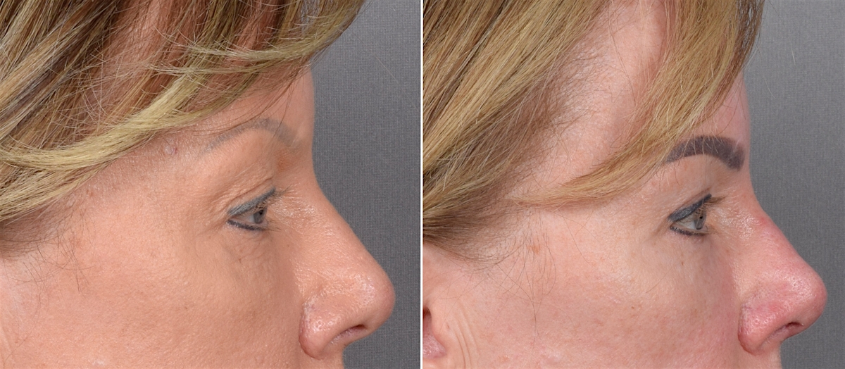 CO2 Laser Before & After Gallery - Patient 401436 - Image 7