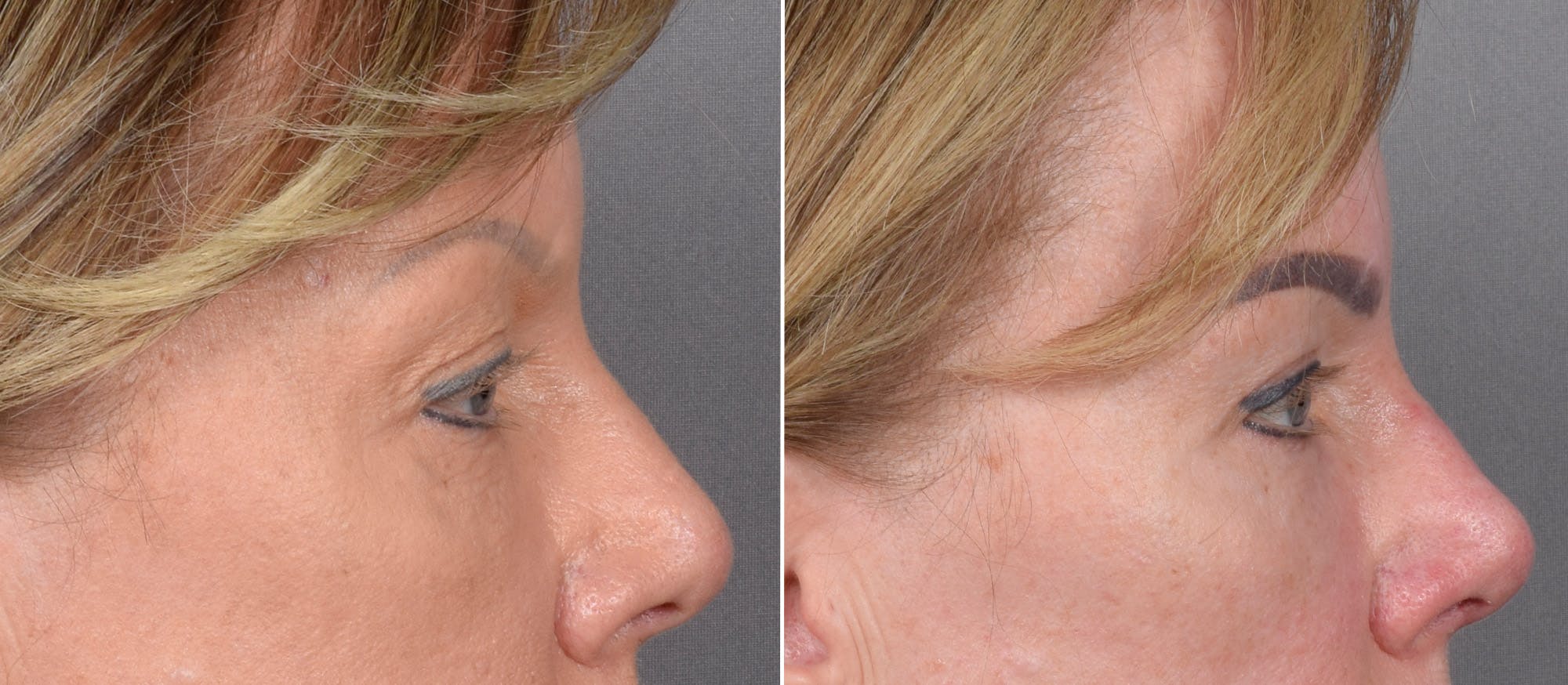 CO2 Laser Before & After Gallery - Patient 401436 - Image 7