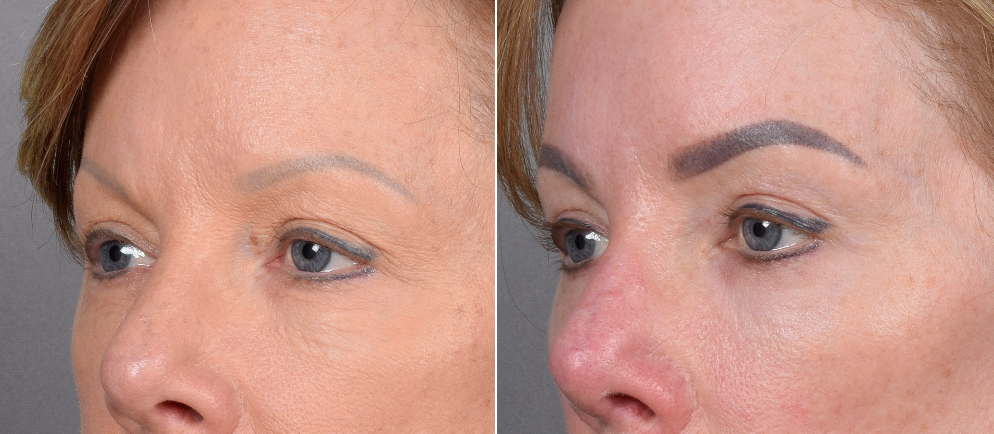 CO2 Laser Before & After Gallery - Patient 401436 - Image 9
