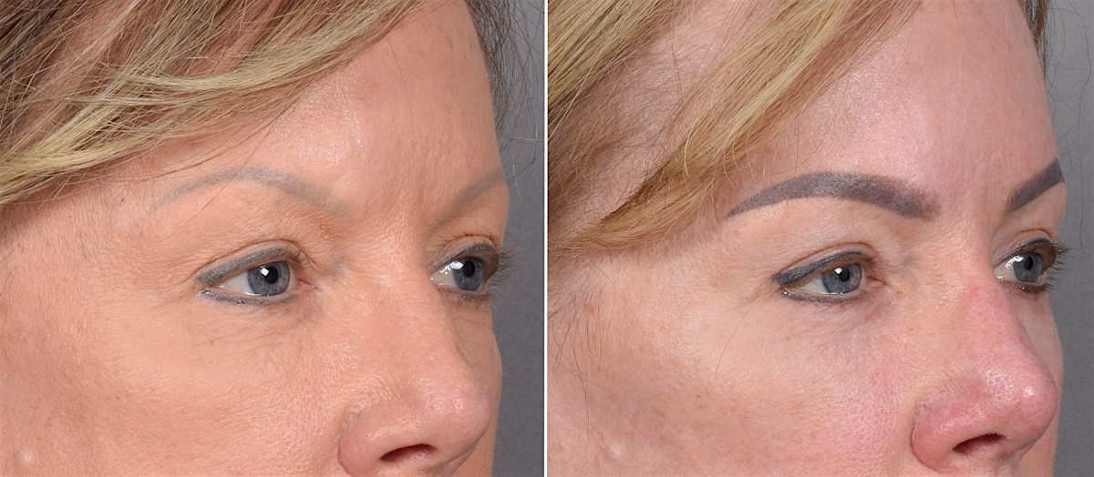 CO2 Laser Before & After Gallery - Patient 401436 - Image 6