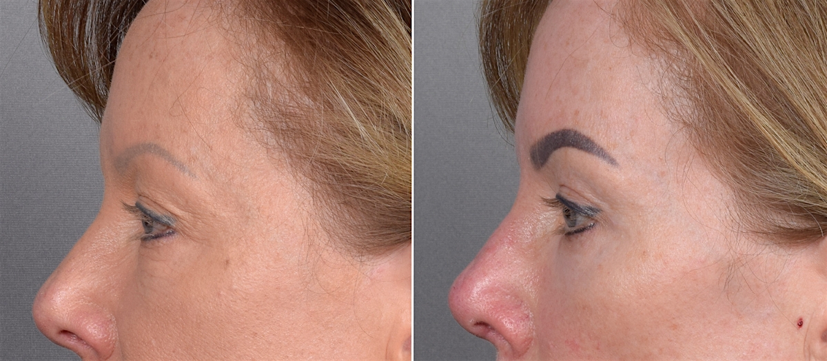 CO2 Laser Before & After Gallery - Patient 401436 - Image 10