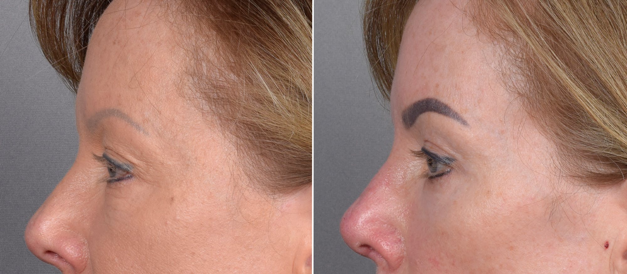 CO2 Laser Before & After Gallery - Patient 401436 - Image 10