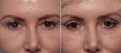 Upper Blepharoplasty Before & After Gallery - Patient 199482 - Image 1