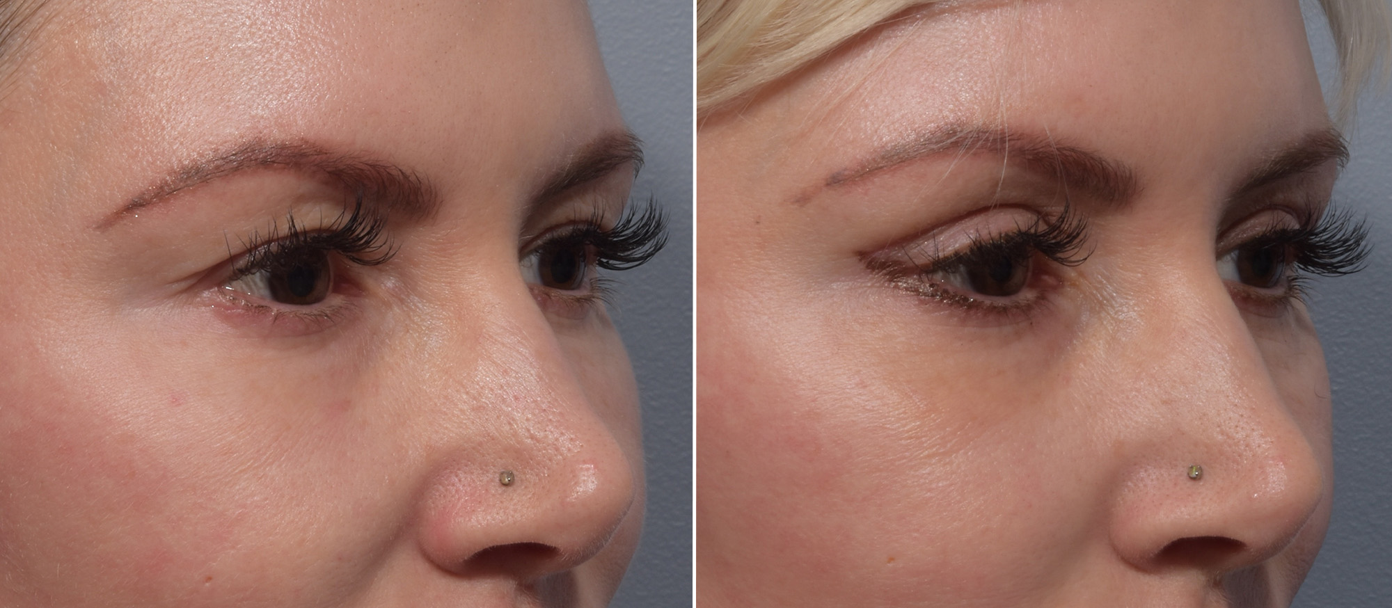 Upper Blepharoplasty Before & After Gallery - Patient 199482 - Image 2