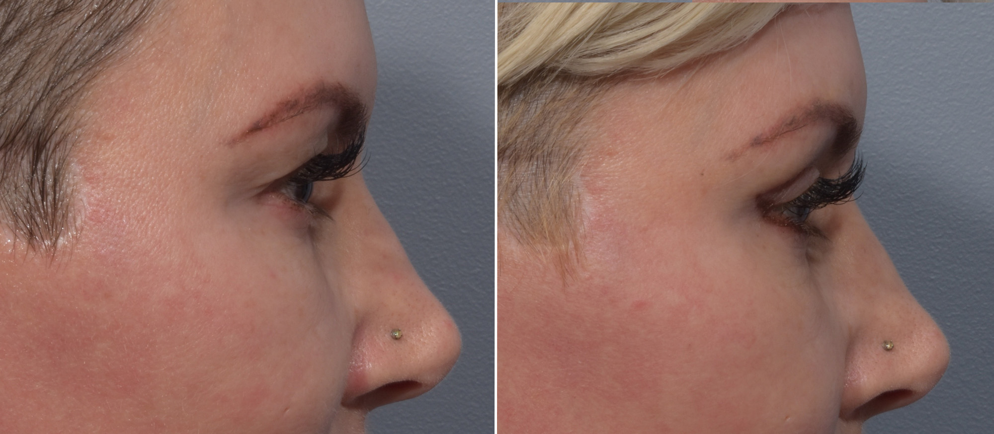 Upper Blepharoplasty Before & After Gallery - Patient 199482 - Image 3
