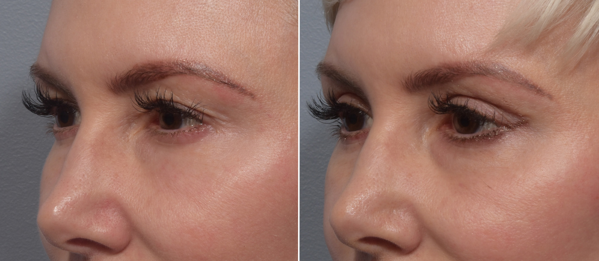 Upper Blepharoplasty Before & After Gallery - Patient 199482 - Image 4
