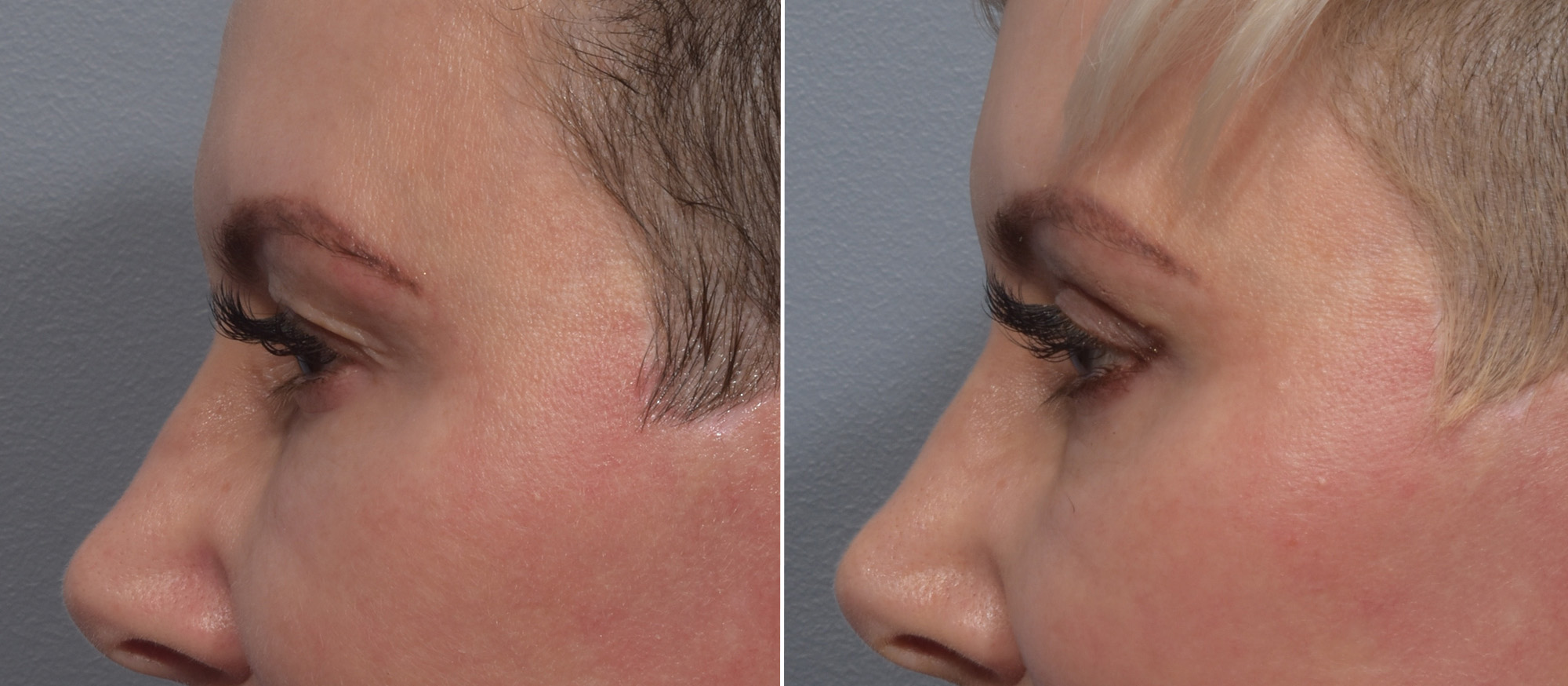 Upper Blepharoplasty Before & After Gallery - Patient 199482 - Image 5