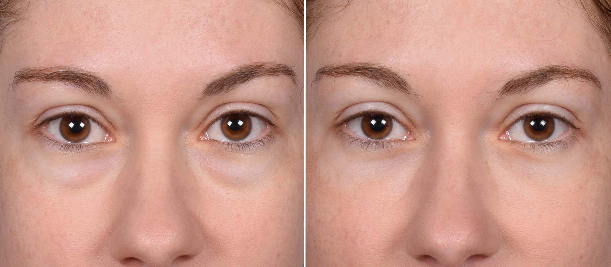 Lower Blepharoplasty Before & After Gallery - Patient 524461 - Image 1