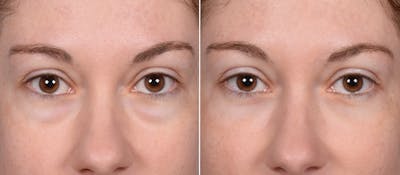 Lower Blepharoplasty Before & After Gallery - Patient 524461 - Image 1