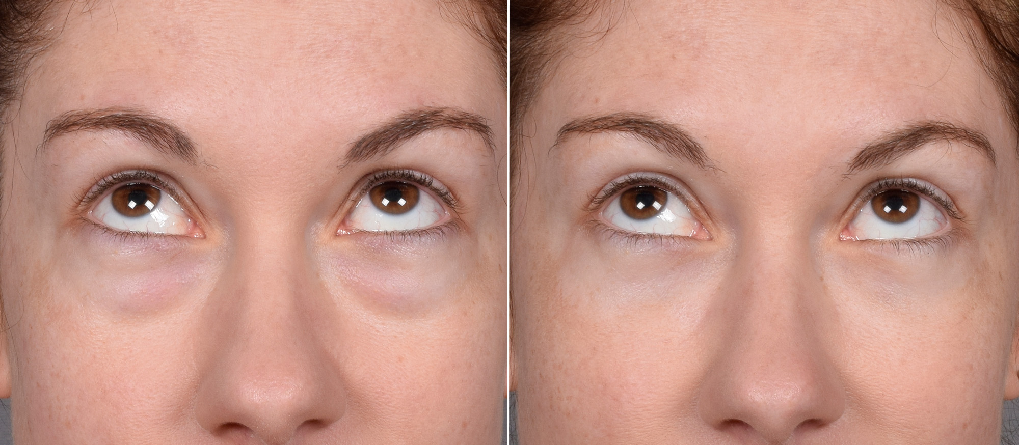 Lower Blepharoplasty Before & After Gallery - Patient 524461 - Image 2