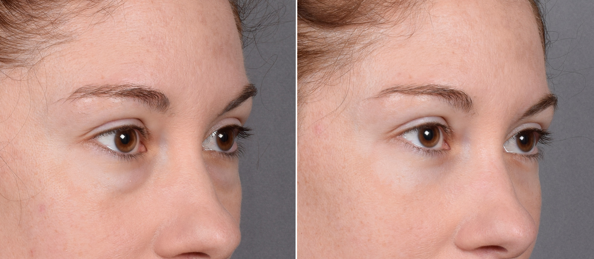 Lower Blepharoplasty Before & After Gallery - Patient 524461 - Image 3