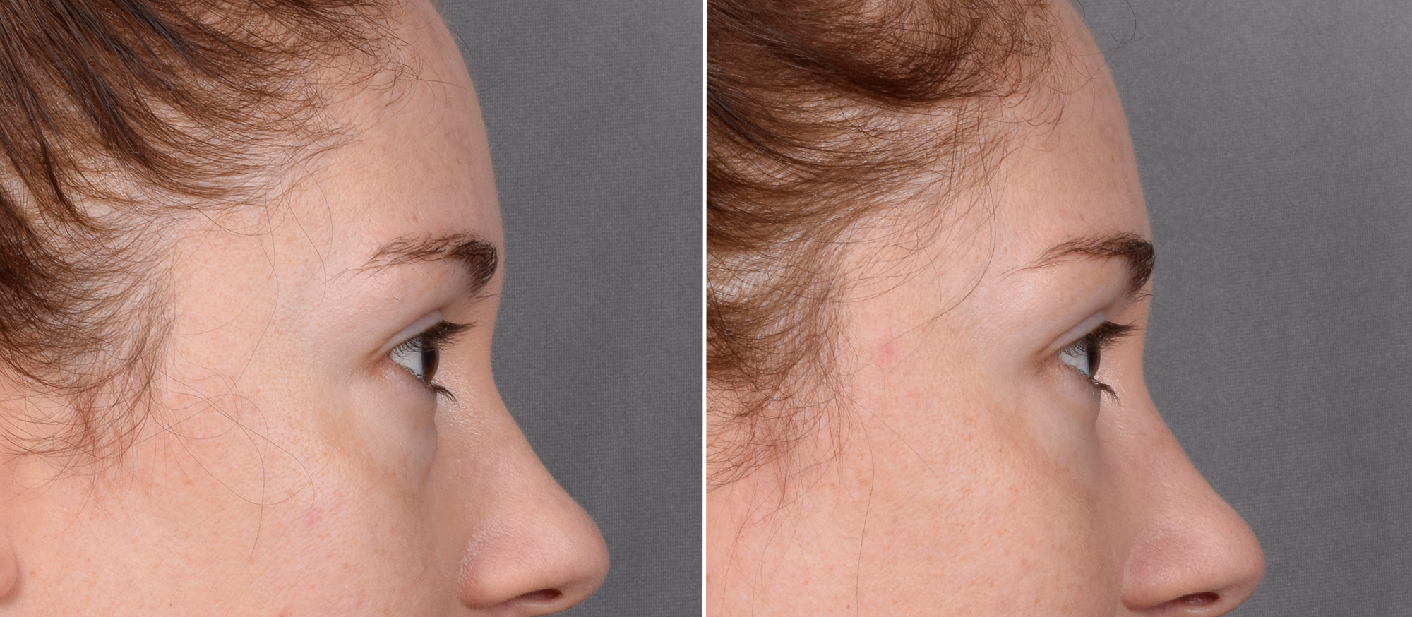 Lower Blepharoplasty Before & After Gallery - Patient 524461 - Image 4