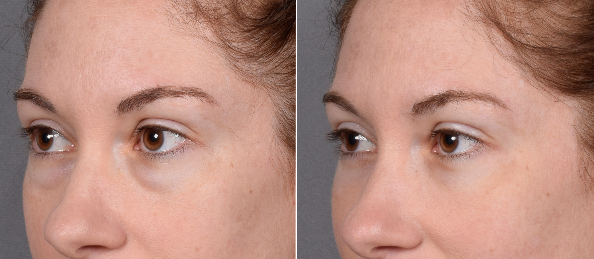 Lower Blepharoplasty Before & After Gallery - Patient 524461 - Image 5
