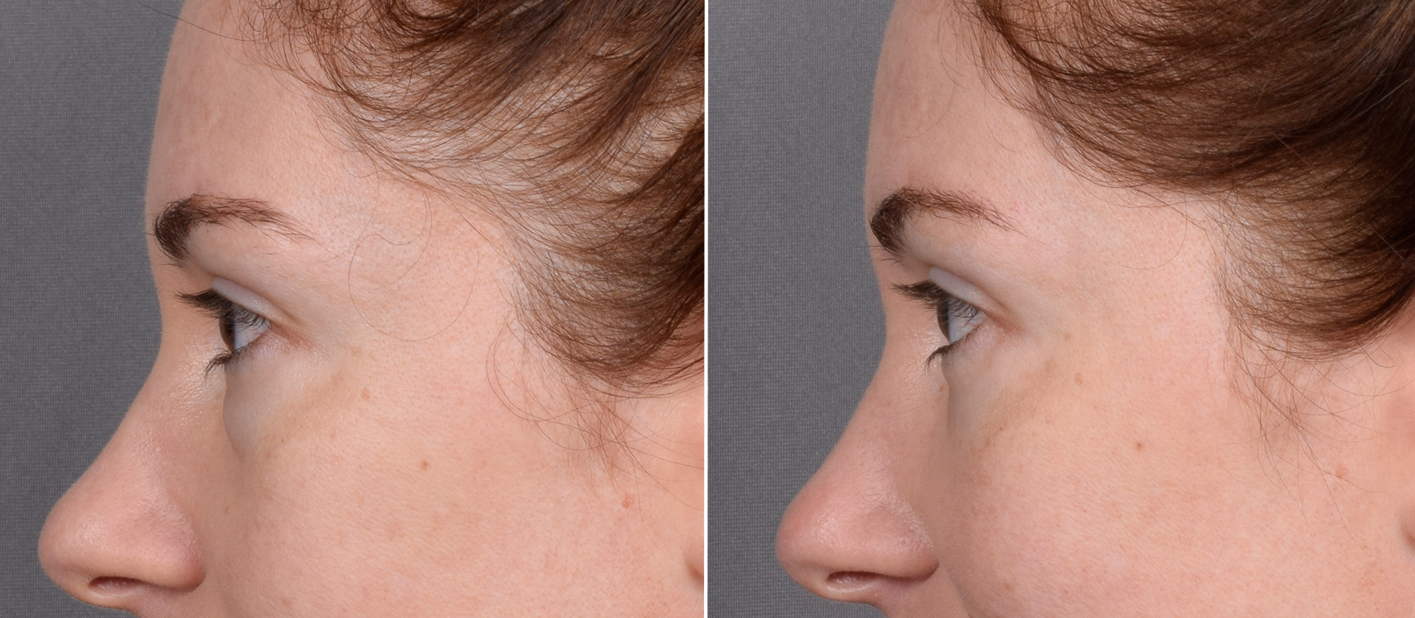 Lower Blepharoplasty Before & After Gallery - Patient 524461 - Image 6