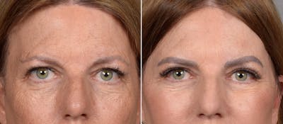 Upper Blepharoplasty Before & After Gallery - Patient 666178 - Image 1