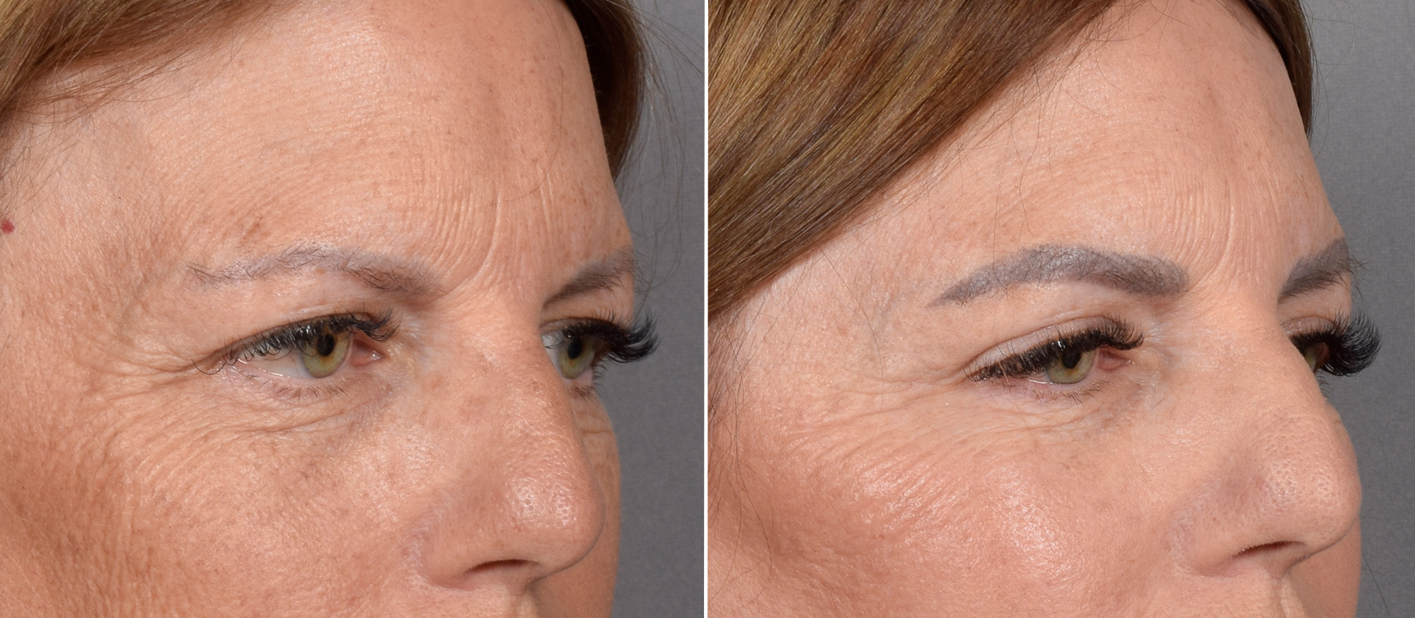 Upper Blepharoplasty Before & After Gallery - Patient 666178 - Image 2