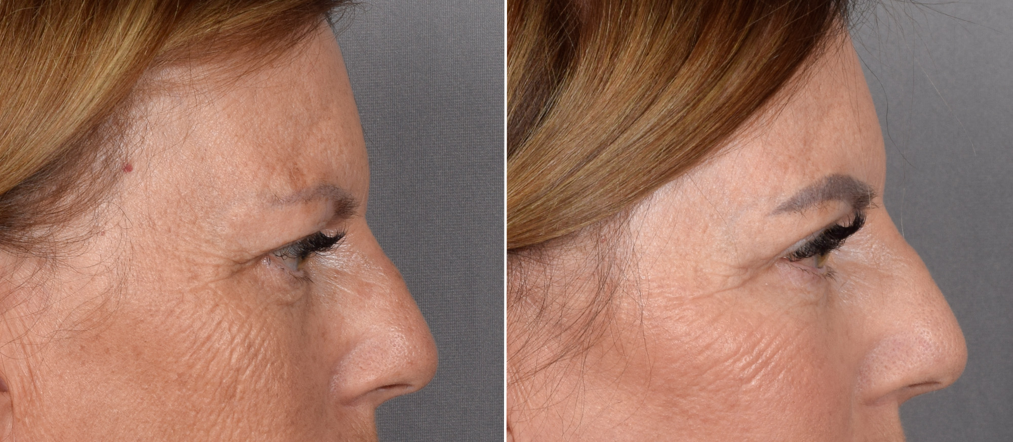 Upper Blepharoplasty Before & After Gallery - Patient 666178 - Image 3