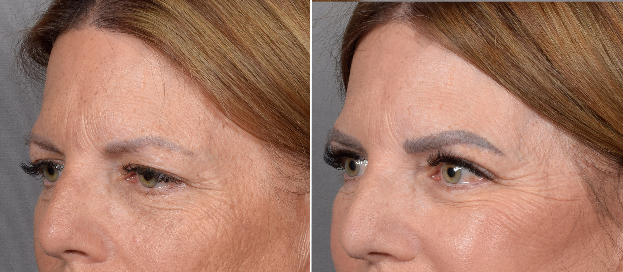 Upper Blepharoplasty Before & After Gallery - Patient 666178 - Image 4