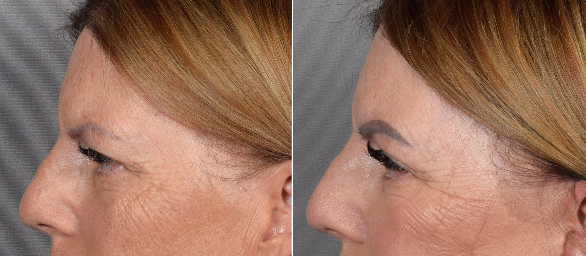 Upper Blepharoplasty Before & After Gallery - Patient 666178 - Image 5